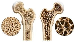 Osteoporosis